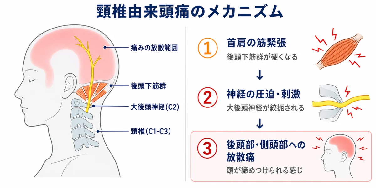 頸椎由来頭痛のメカニズム — 首肩の筋緊張(後頭下筋群)→大後頭神経の圧迫→後頭部・側頭部への放散痛