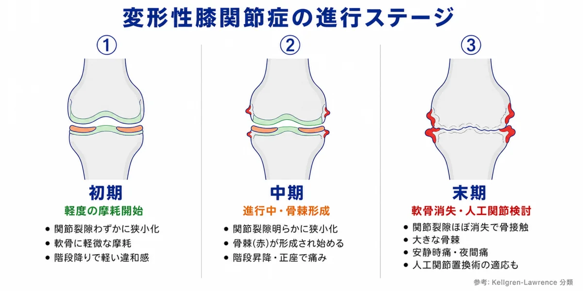 変形性膝関節症の進行ステージ — 初期(軽度の摩耗)・中期(骨棘形成)・末期(軟骨消失・人工関節検討)