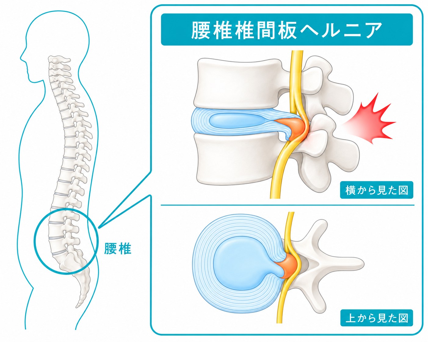 腰椎椎間板ヘルニアの解剖図 — 腰椎の位置と髄核突出による神経根圧迫(横から見た図・上から見た図)