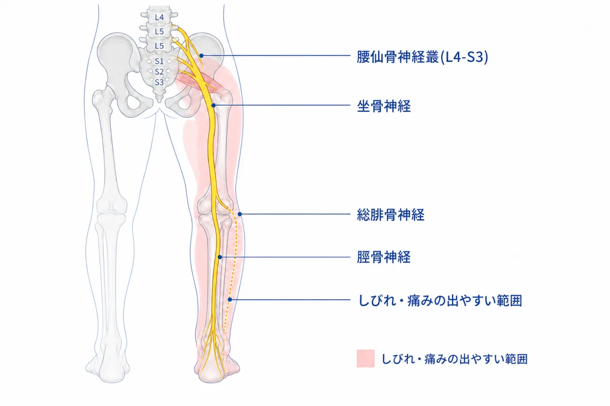 坐骨神経の走行図 — 腰仙骨神経叢(L4-S3)からお尻・大腿後面・ふくらはぎへ走行、しびれ・痛みの出やすい範囲