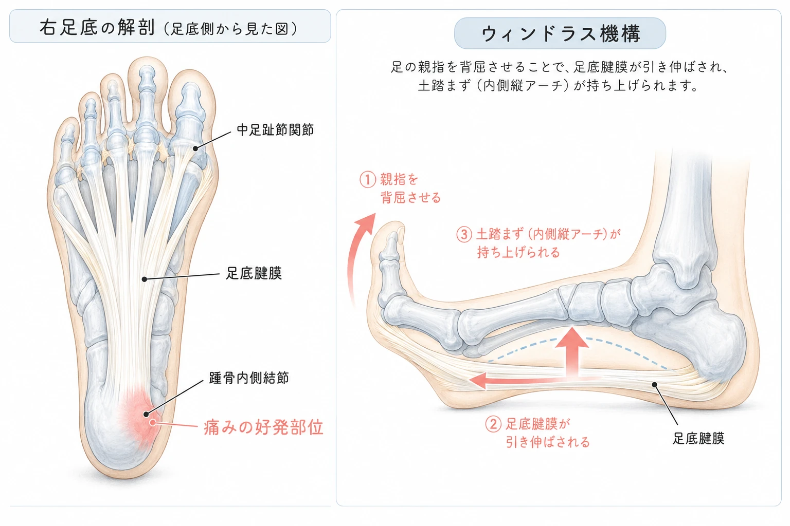 足底腱膜の解剖図 — 踵骨内側結節から中足趾節関節までの扇状腱膜と痛みの好発部位（左）、足の親指を背屈させることで足底腱膜が引き伸ばされ土踏まずが持ち上がるウィンドラス機構（右）